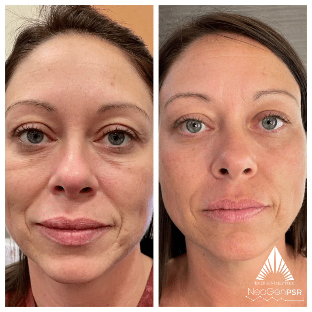 Woman before and after NeoGen Lift treatment.