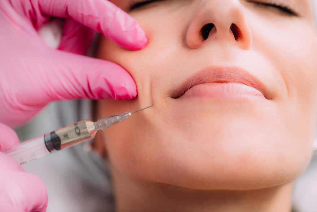 Woman getting her nasolabial folds injected with dermal filler.