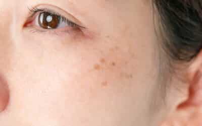 Hyperpigmentation: Best Treatments, Prevention, & Long-Term Care