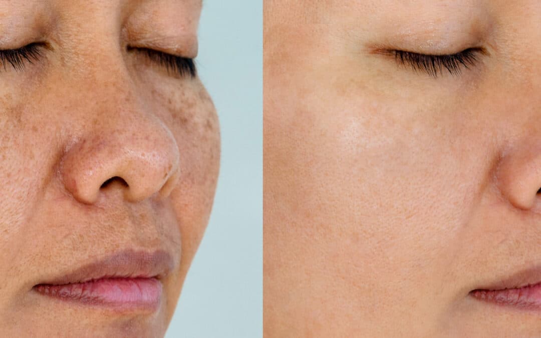 Treat Sun Damage and Reclaim Your Radiance with NeoGen Plasma